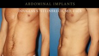 Biasanya implan dimasukkan ke perut lewat dua sayatan kecil. Menurut dr Doughlas butuh waktu sekitar seminggu sebelum seorang pasien bisa mulai beraktivitas kembali. (Foto: instagram/maleplasticsurgery)