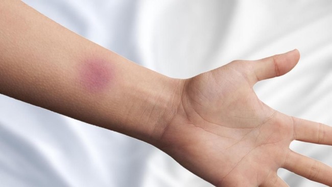 Sering Lebam Tiba-tiba? 4 Kemungkinan Penyebab Memar di Tubuh (2)