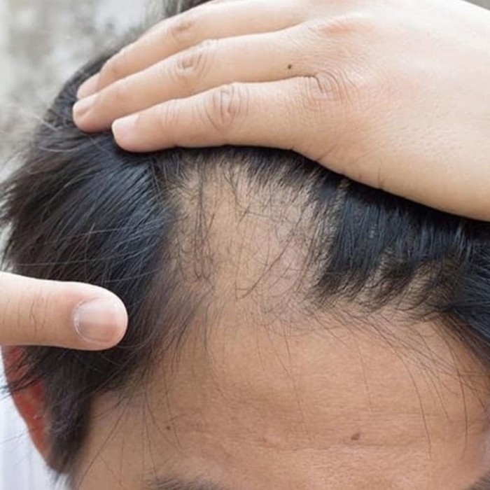 Peneliti Terkejut, Ada Metode yang Cepat Menumbuhkan Rambut