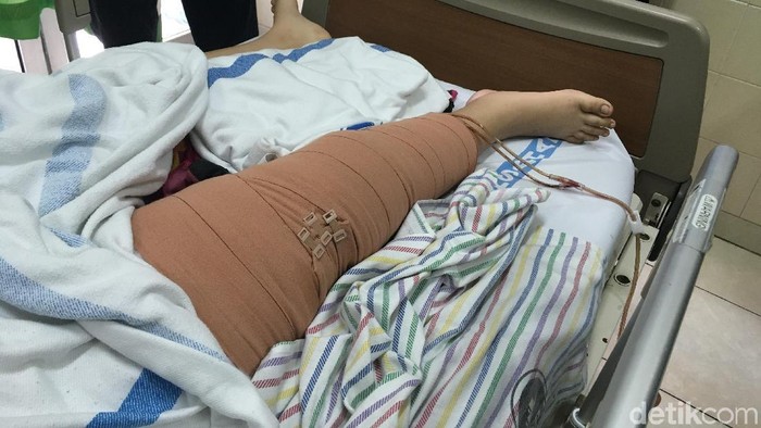 apriliani kanker tulang osteosarcoma