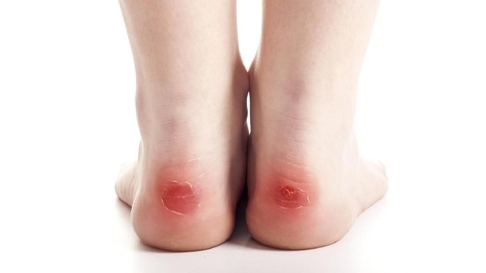 Kaki melepuh gara-gara kena getah ubi liar. Foto: Thinkstock Kaki melepuh gara-gara kena getah ubi liar. Foto: Thinkstock