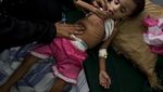 Potret Miris Anak-anak Malnutrisi dan Stunting di Seluruh Dunia