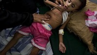Malnutrisi merupakan masalah serius di Yaman. Sekitar 58 persen anak mengalami stunting akibat kurang makanan bergizi. (Foto: Getty Images)