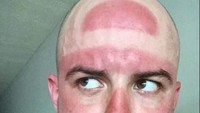 Menjadi botak dan mengalami sunburn bukanlah kombinasi yang baik. Foto: Internet