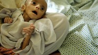 Bayi berusia empat bulan dari Afganistan dengan malnutrisi parah. Sekitar setengah anak-anak di sana mengalami stunting. (Foto: Getty Images)