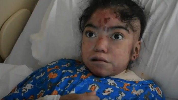 Idap Penyakit Kulit Langka, Gadis Ini Selalu Terbungkus Perban