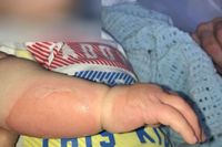 Duh! Pelayan Taruh Sup Panas Sembarangan, Tangan Balita Ini Melepuh