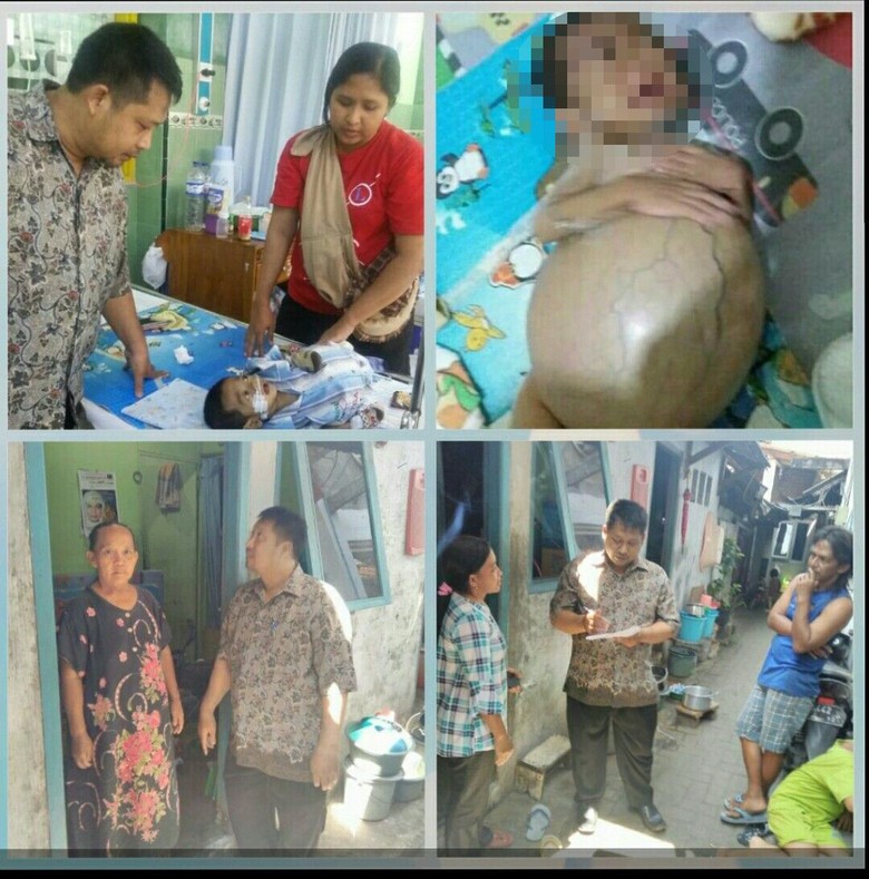 Ardan, Bayi Atresia Bilier yang Viral karena Butuh Cangkok Hati Ardan, Bayi Atresia Bilier yang Viral karena Butuh Cangkok Hati