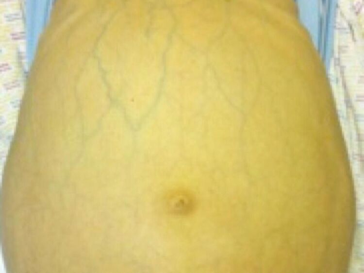 5 Gejala Hepatitis dalam Gambar