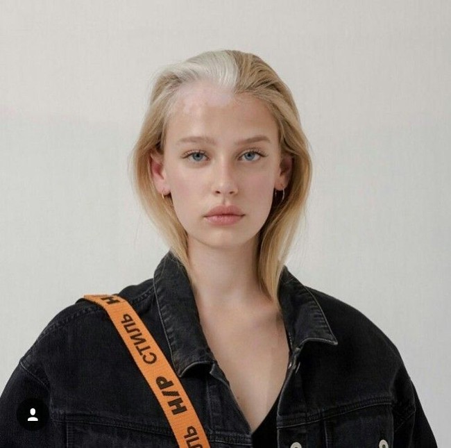 Tia mengalami kondisi vitiligo. Vitiligo merupakan kondisi kelainan kulit akibay pigmentasi yang hilang. Sehingga di beberapa bagian kulit, warnanya memutih. Foto: Dok. Instagram (@tiajonsson)