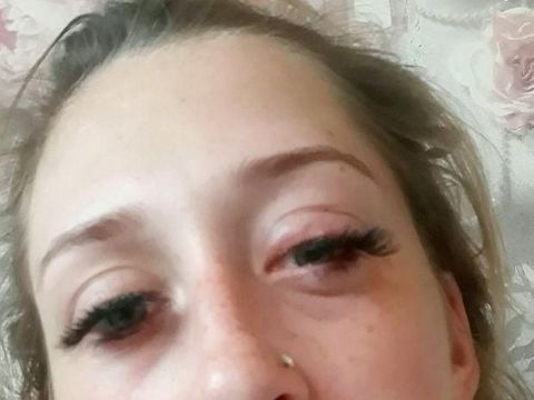 Ilustrasi wanita yang matanya sakit akibat extension bulu mata.