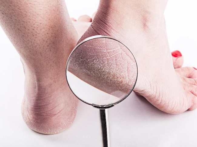 Dry heels woman on a white background close-up through a magnifying glass