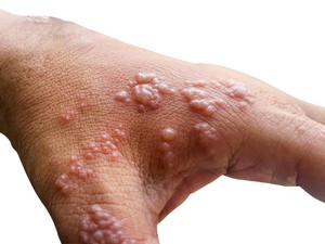 Kenali Gejala Herpes Zoster, Penyebab, dan Cara Mengobatinya