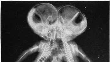 Seperti ini bayi kembar yang dempet. (Foto: Brightside)