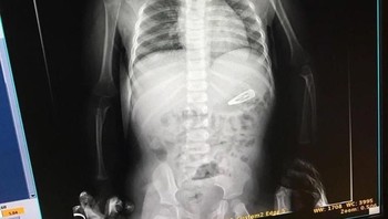 Ada-ada saja,anak gadis ini menelan jepitan rambut. (Foto: Brightside)