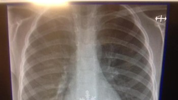 “Putra temanku menelan kepingan salju.” (Foto: Brightside)