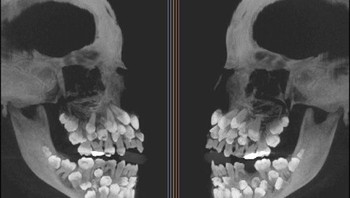 Penampakan seseorang yang mengalami Hyperdontia, merupakan kondisi mulut yang ditandai dengan jumlah gigi yang berlebih, di mana seseorang memiliki lebih dari 20 gigi primer atau lebih dari 32 gigi permanen. (Foto: Brightside)