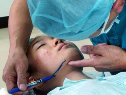 Ini Operasi Berbahaya yang Dilakukan Artis Korea Supaya Cantik dan Ganteng