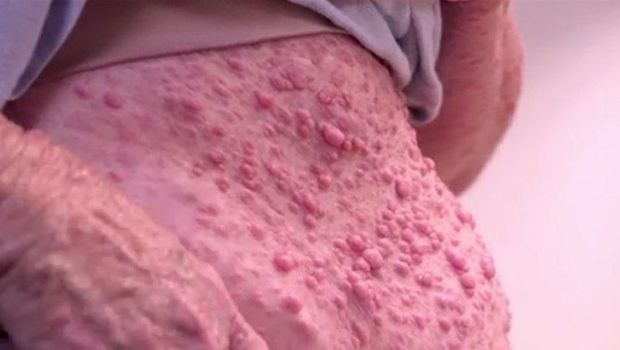 Wanita yang Hidup dengan Ribuan Tumor di Wajah Hingga Tubuh 
