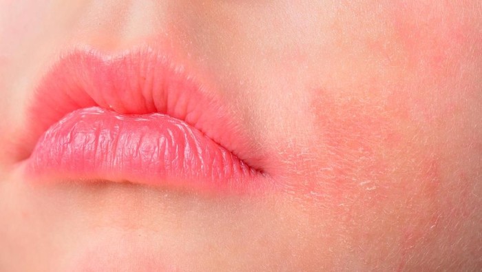 Dermatitis Atopik Pada Anak Dapat Muncul Dengan Gejala Kulit Gatal Kemerahan Foto Thinkstock Dermatitis Atopik Pada Anak Dapat Muncul Dengan Gejala Kulit Gatal Kemerahan Foto Thinkstock