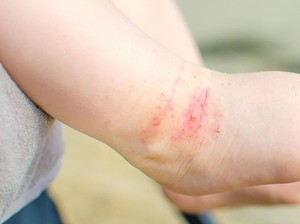 Terpenjara di Rumah, Bayi Ini Punya 50 Jenis Alergi
