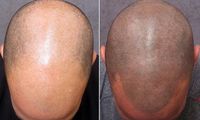 Cara Mudah Menumbuhkan Rambut, Lakukan Sekarang!