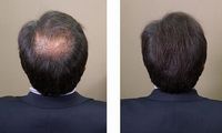 Cara Mudah Menumbuhkan Rambut, Lakukan Sekarang!