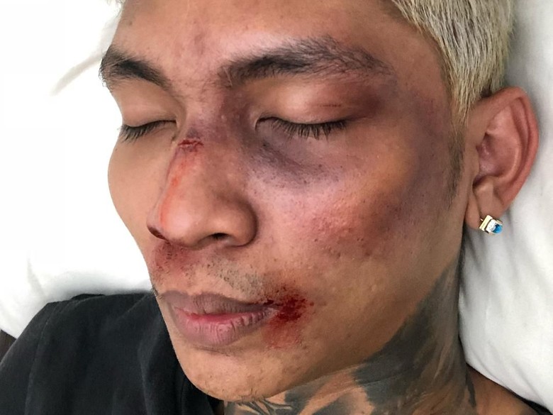 Ngaku Berantem dengan Fans K-Pop, Begini Wajah Babak Belur 