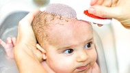 Cradle Cap, Penyebab Kepala Bayi Berkerak Seperti Ketombe