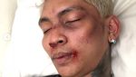 Jujur Dong Young Lex, Babak Belur atau Makeup?