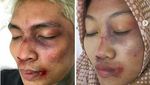 Kocak! Aksi Fans Meniru Wajah Babak Belur Young Lex
