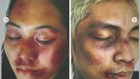 3. Yang lebih parahnya, mereka tak tanggung-tanggung tampil terlihat asli seperti habis dipukuli. Foto: Instagram Young Lex