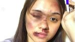Kocak! Aksi Fans Meniru Wajah Babak Belur Young Lex