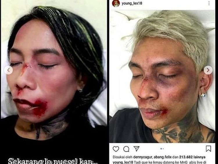 Kocak! Aksi Fans Meniru Wajah Babak Belur Young Lex