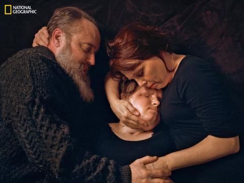 Wanita Termuda yang Lakukan Transplantasi Wajah, Begini Penampilan Barunya