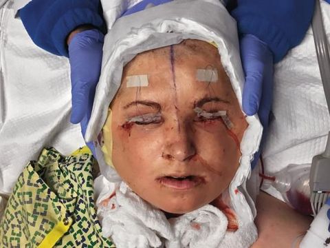 Wanita Termuda yang Lakukan Transplantasi Wajah, Begini Penampilan Barunya