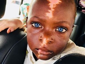 Mereka Bermata Biru Indah Karena Sindrom Waardenburg