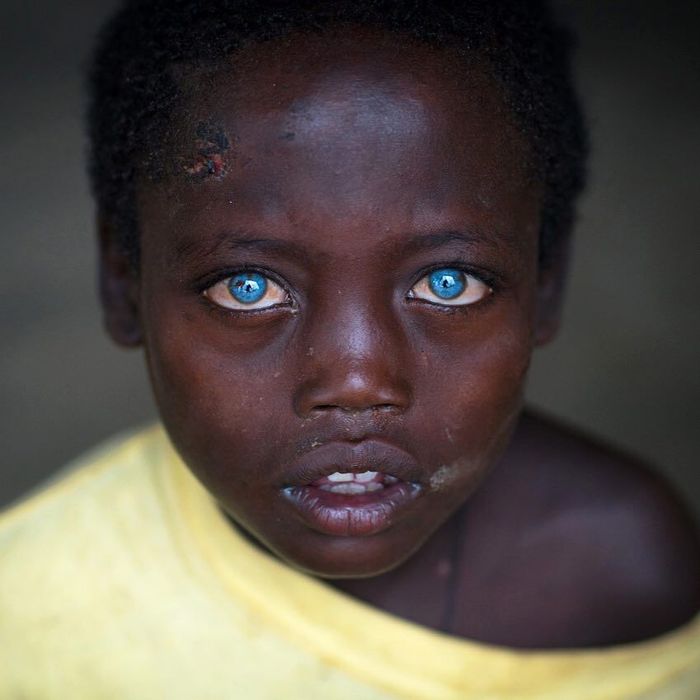 Mereka Bermata Biru Indah Karena Sindrom Waardenburg