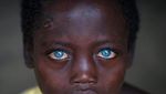Mereka Bermata Biru Indah Karena Sindrom Waardenburg