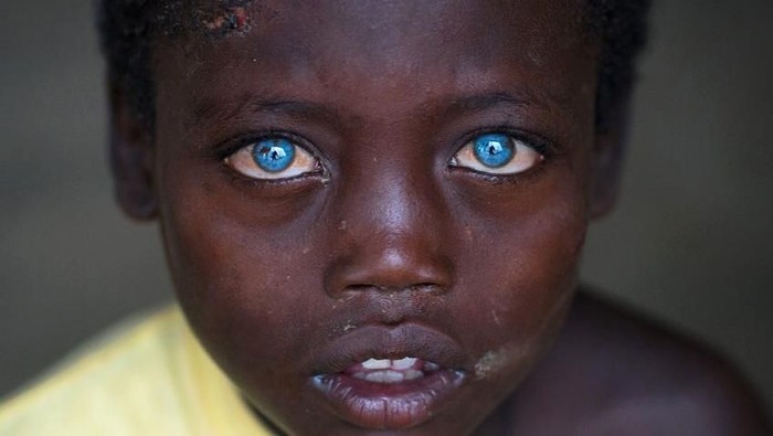 Abushe dengan mata biru karena Sindrom Waardenburg. Foto: Instagram/ericlafforgue Abushe dengan mata biru karena Sindrom Waardenburg. Foto: Instagram/ericlafforgue