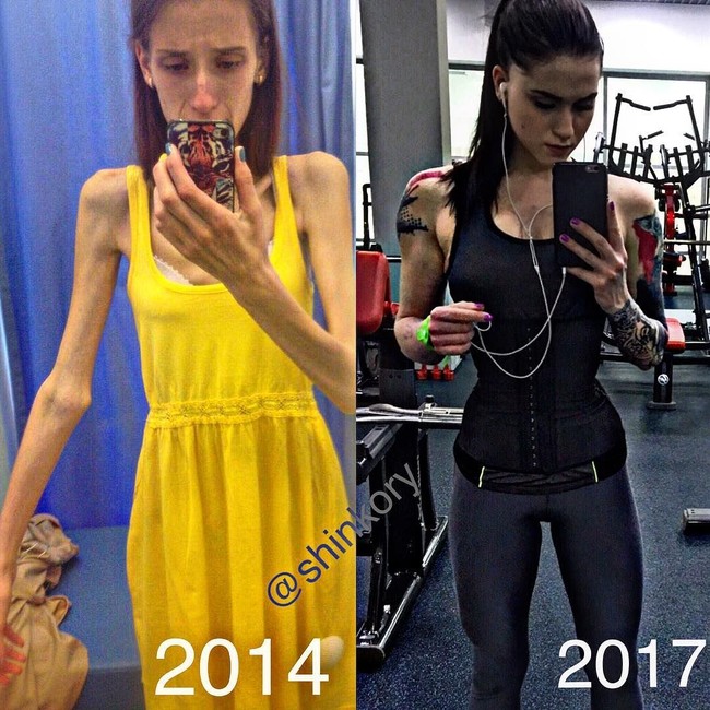 Wanita berusia 19 tahun ini pernah menjadi sangat kurus tanpa disadari oleh keluarganya. Kesehatan Vera juga memburuk karena terlalu kurus. Foto: Instagram