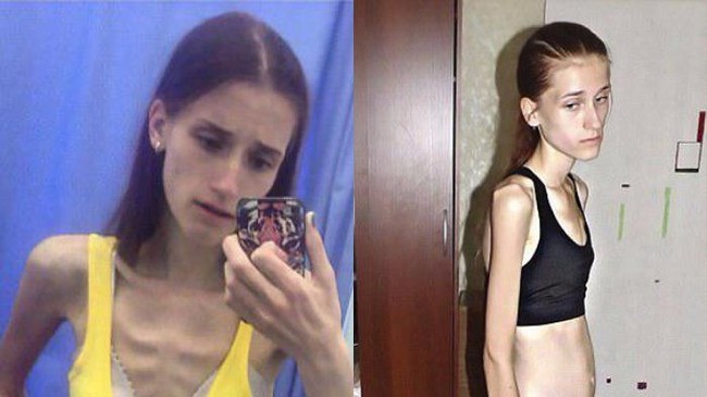 Pada 2014 Vera Schulz menderita anoreksia dan beratnya hanya 31 kilogram, namun kini ia telah pulih dan menjadi instruktur kebugaran. Foto: Instagram