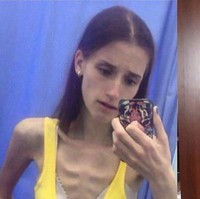 Pada 2014 Vera Schulz menderita anoreksia dan beratnya hanya 31 kilogram, namun kini ia telah pulih dan menjadi instruktur kebugaran. Foto: Instagram