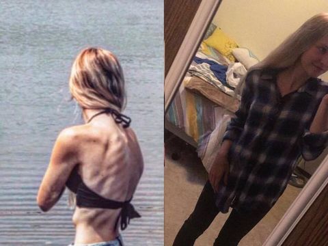 Kiri: Nicole saat beratnya 33 Kg. Kanan: Nicole yang sudah menjalani pengobatan