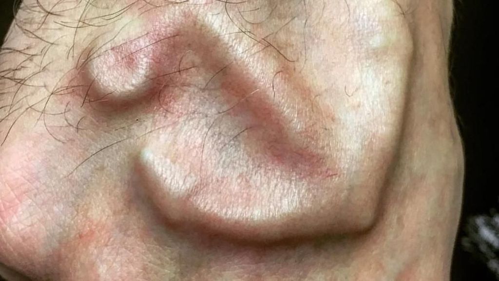 Keren atau Geli? Potret Tato Implan yang Menyembul di Kulit Keren atau Geli? Potret Tato Implan yang Menyembul di Kulit