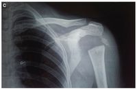 Hasil pemindaian radiografi, beberapa tulang bahu tidak ada.