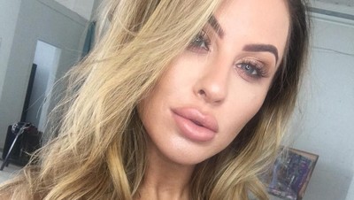 Potret Selebgram yang Bibirnya Kempes Setelah Hapus Filler ala Kylie Jenner