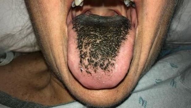 Wanita ini mengidap black hairy tongue.