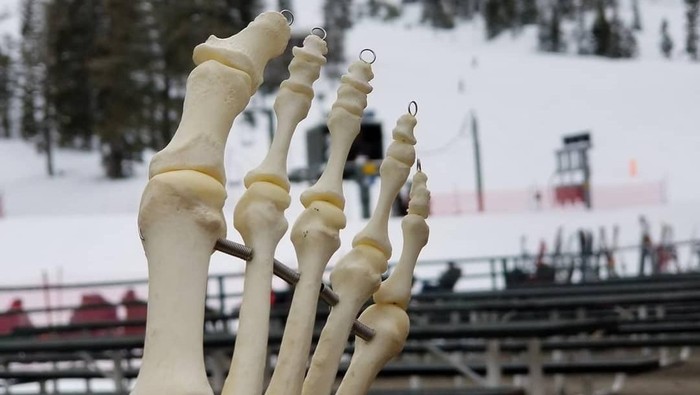 Kaki Amputasi Korban Kanker Bisa Keliling Dunia dan Punya Akun Instagram