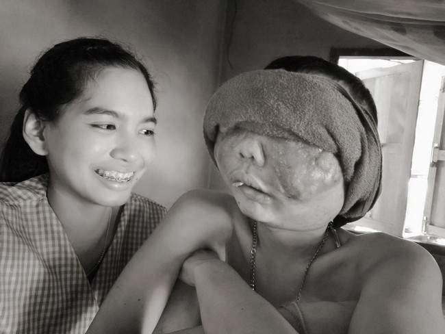 Pooh menderita retinoblastoma, bentuk kanker langka yang dimulai di retina, bagian dari mata yang bertanggung jawab untuk deteksi cahaya. Foto: Dok. Facebook Atittaya Chumkeaw